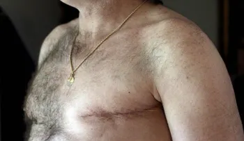 Aumentan las mastectomías dobles en hombres con cáncer de mama