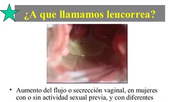 Una mujer con leucorrea puede tener una secreción vaginal pegajosa: Síntomas y tratamiento