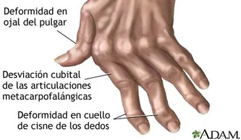 Con este te que tiene en tu CASA cura la artritis, la fibromialgia y las infecciones de garganta 
