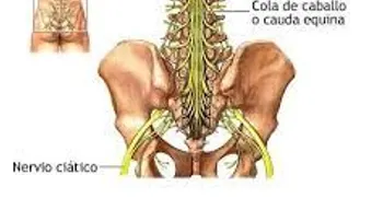 El tratamiento médico para un nervio ciático