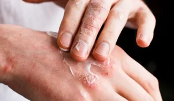 Terapias para tratar la psoriasis de manera efectiva 