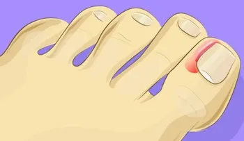 Es fácil tratar las uñas enterradas sin necesidad de operar (VIDEO)