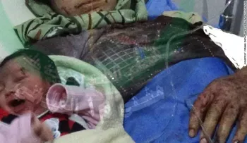 Guerra civil en Siria: nace una bebé con herida de metralla en la frente