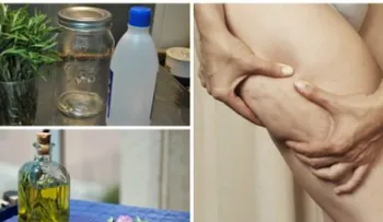 Alcohol de romero casero para combatir la celulitis