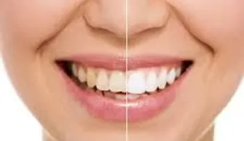 Blanquea tus dientes en 15 min con esta receta: Ningún dentista te lo dirá