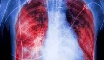 Qué es la neumonía bilateral y qué produce en el cuerpo