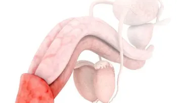 Balanitis: síntomas y tipos de balanitis; cómo controlarlo