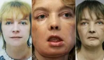 Muere primera mujer con trasplante en la cara: principales trasplantes en el mundo