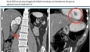 Tac abdominopelvica sin contraste