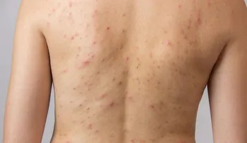 Acné en la espalda y pecho causas y tratamientos naturales