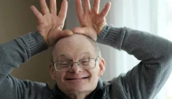 Describen la historia natural del Alzheimer en personas con síndrome de Down