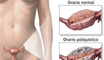 Síndrome de Ovario Poliquístico: un padecimiento aleatorio entre las mujeres