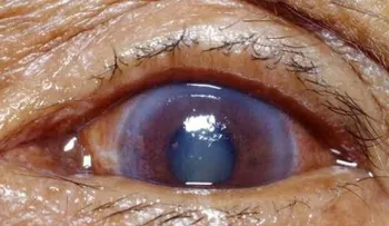 El glaucoma se roba silenciosamente la vista