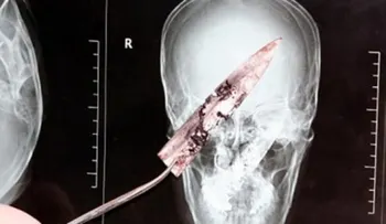 Un hombre vivió cuatro años con un cuchillo incrustado en la cabeza 
