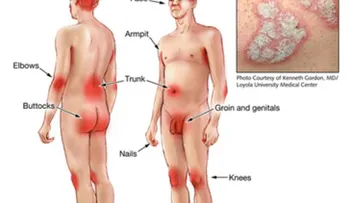 La Psoriasis puede mejorar con un estilo de vida saludable, Día Mundial 29Oct