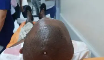 Un joven (Natanael García), se clava un clavo en la cabeza, porque sintió el cerebro flojo; lograron salvarlo 