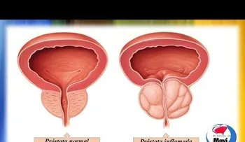 Anótalo: Remedios caseros para la prostata inflamada o prostatitis