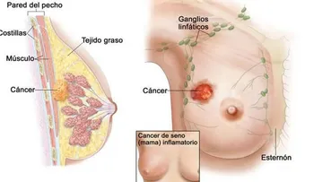 El país de origen mejoraría detención de cáncer de seno en latinas