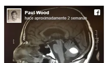 Ocurrió un milagro: Desaparece tumor cerebral, justo antes de ser operado por los médicos 