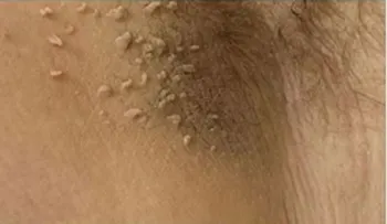 ¡Todos Las Tenemos Pero Nadie Sabe Quitarlas Fácilmente! Este Truco Quita-Verrugas Hace Maravillas!!