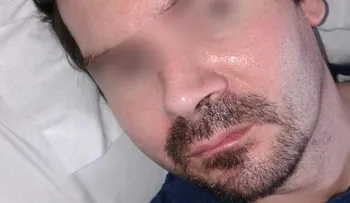 El tribunal de Estrasburgo autoriza a dejar morir a un tetrapléjico francés