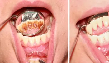 Como eliminar el sarro de los dientes en tan solo 5 minutos y sin gastar un centavo en dentista!