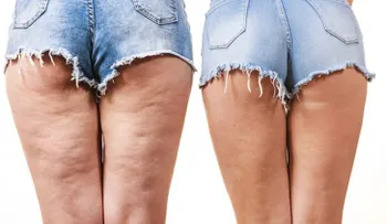Elimina la celulitis con la semilla del aguacate