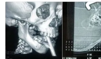 Niña china sobrevive después de que una barra de hierro le perforó el cerebro 