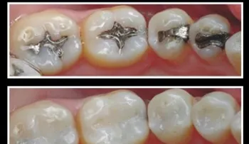 Despídete para siempre del metal en los dientes