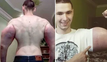 "Popeye": el joven fisicoculturista ruso al que critican por inyectarse aceite en los brazos