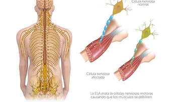 Esclerosis lateral amiotrófica: Enfermedad que provoca la muerte por insuficiencia respiratoria