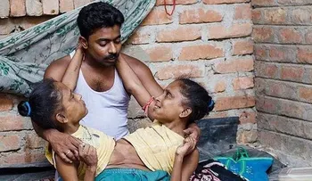 Dos siamesas en la India se enamoran del mismo hombre