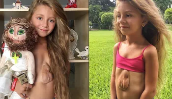 El impactante caso de la niña que nació con el corazón fuera del pecho y cuenta su historia en Instagram