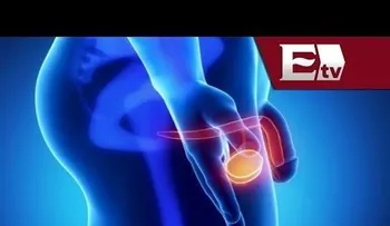 Doctor Víctor Corona: Cáncer de próstata: Síntomas y factores de riesgo