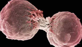  La inmunoterapia lograr por 1ra vez eliminar por completo un cáncer de mama 