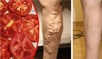 Tenía mis piernas llenas de varices y un doctor me dijo que usará el tomate de esta forma para desaparecerlas