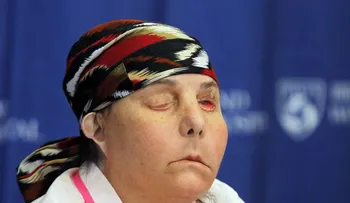 Muestra su rostro la primera persona en recibir dos trasplantes de cara en EE.UU. 