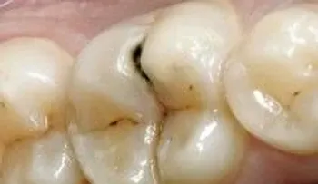 ¡Una técnica probada para curar las caries de los dientes para siempre!