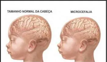 Esperan más casos de microcefalia en el país