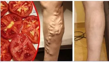 Mis piernas estaban llenas de varices y un doctor me dijo que usará el tomate de esta forma para borrarlas