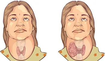 El bocio, sus causas, factores de riesgo y tratamientos naturales