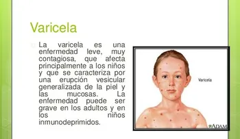  La varicela es una enfermedad sumamente contagiosa, afecta niños y personas mayores