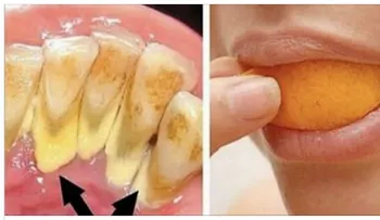 Elimina el sarro y blanquea tus dientes en 15 min con esta receta que un dentista jamás te dirá !
