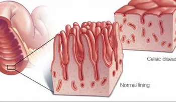 Seguir una dieta estricta sin gluten es importante para quien padece enfermedad celíaca