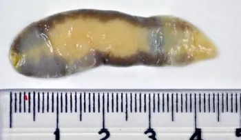 Trematodiasis: una enfermedad que puede infectar verduras, pescados y mariscos y que mata a 7 mil personas cada año