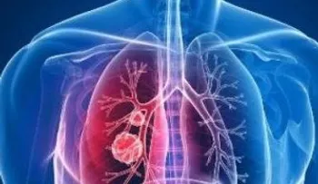 Demuestran que un gen del cáncer común también causa malformaciones venosas