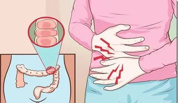 Ella logró terminar con la Gastritis y Colitis con un sólo Remedio, mira como lo hizo