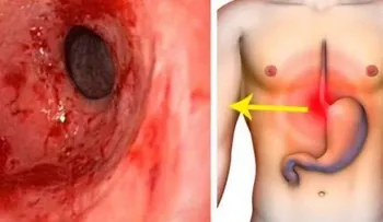 Elimina la gastritis y la acidez estomacal de por vida con este eficaz remedio
