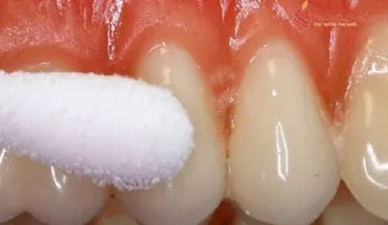Elimina el dolor de muelas en 1 minuto con este remedio casero!!!