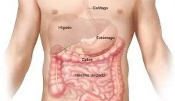 Cáncer de colon: qué es; causas y tratamientos (VIDEO)